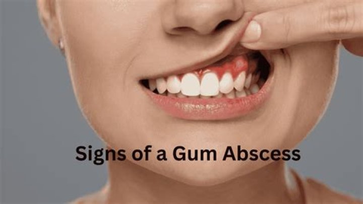 Don't Ignore Gum Abscess! Get Relief Now