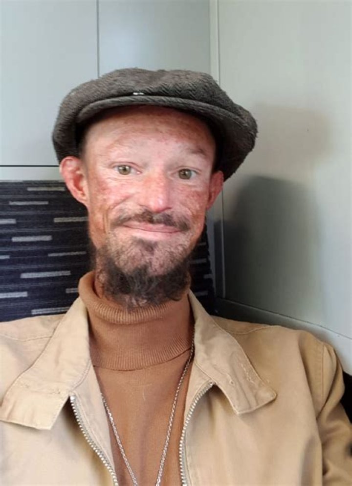 Darren Kent's Fight Against Mysterious Skin Disorder