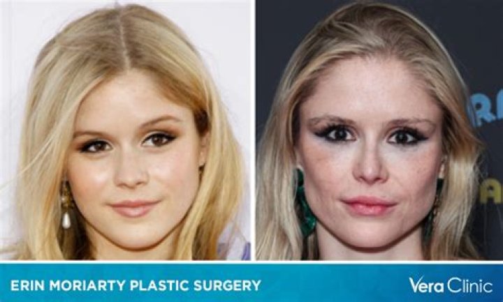 Erin Moriarty's Nose Job Expert Insights Revealed