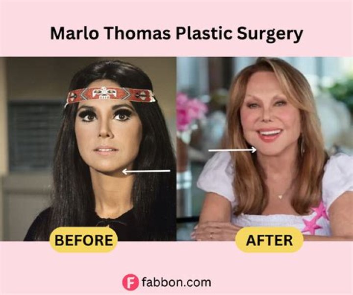 Has Marlo Thomas Gotten Work Done? Exploring Her Transformation
