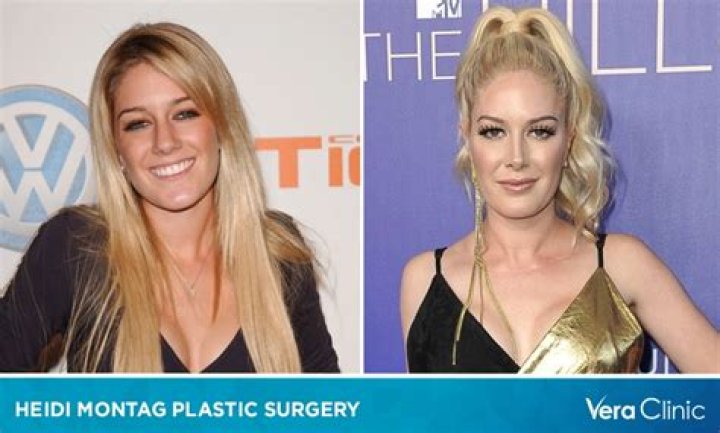 The Shocking Evolution Of Heidi Montag's Plastic Surgery Journey