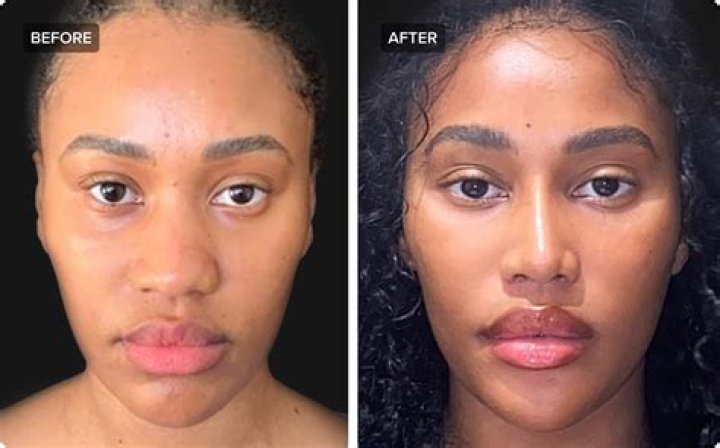 Unveiling Jisoo's Transformation: Before And After Rhinoplasty