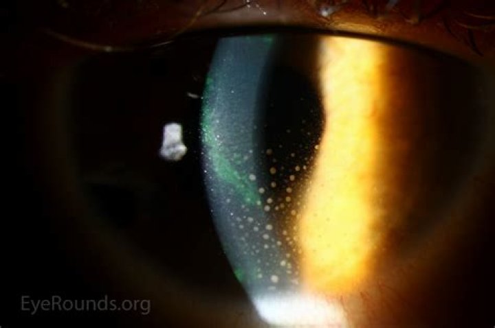 KP Eye: A Complete Guide To Keratopathy Prognosis