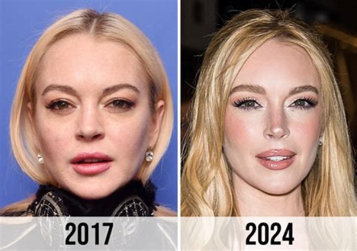 Unveiling The Truth About "Lindsey Lohan Botox": Discoveries And Insights