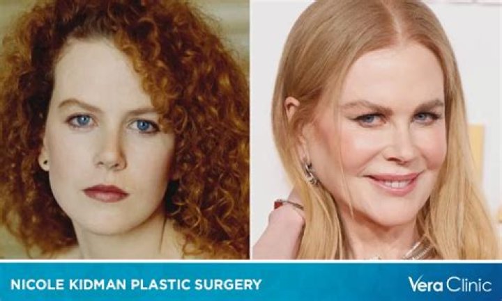All About Nicole Kidman's Plastic Surgery: Enhancements And Procedures