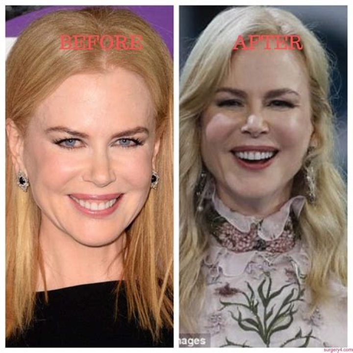Uncovering The Truth Behind Nicole Kidman's Alleged Surgeries