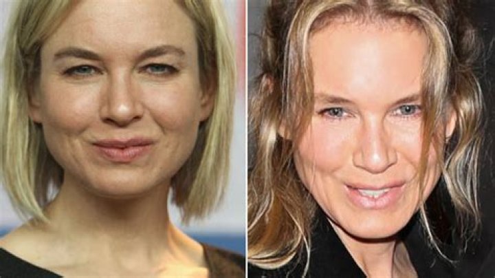 Renee Zellwegers Face She Got Plastic Surgery, Docs Say Hollywood Life |