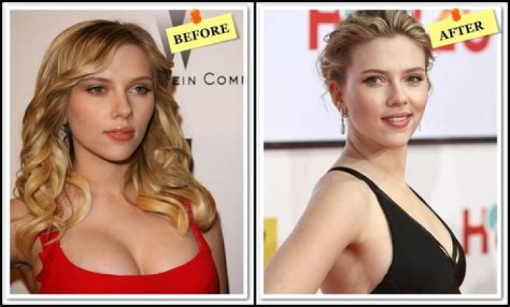 Scarlett Johansson's Plastic Surgery Journey Revealed