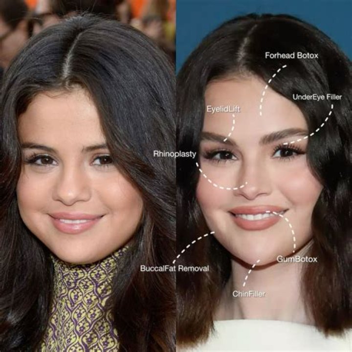 Selena Gomez Undergoes Eye Surgery: Reasons And Recovery
