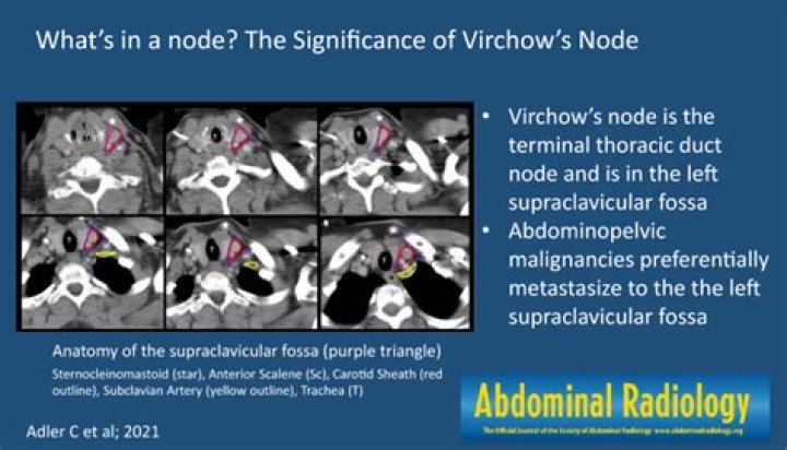 An Overview Of Virchow's Node: Causes And Significance