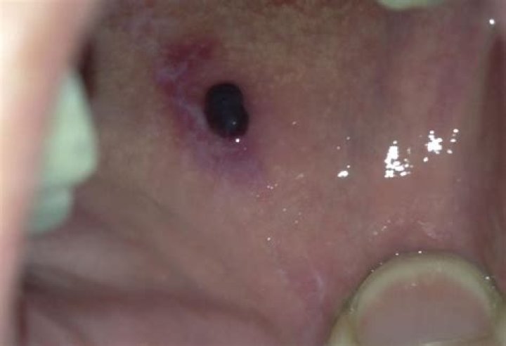 Discover The Root Causes Of Blood Blisters In Your Mouth