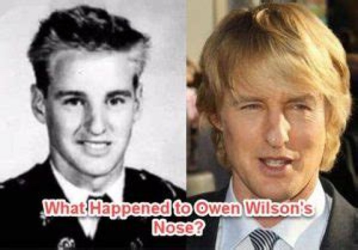 Owen Wilson's Nose And Its Extraordinary Journey