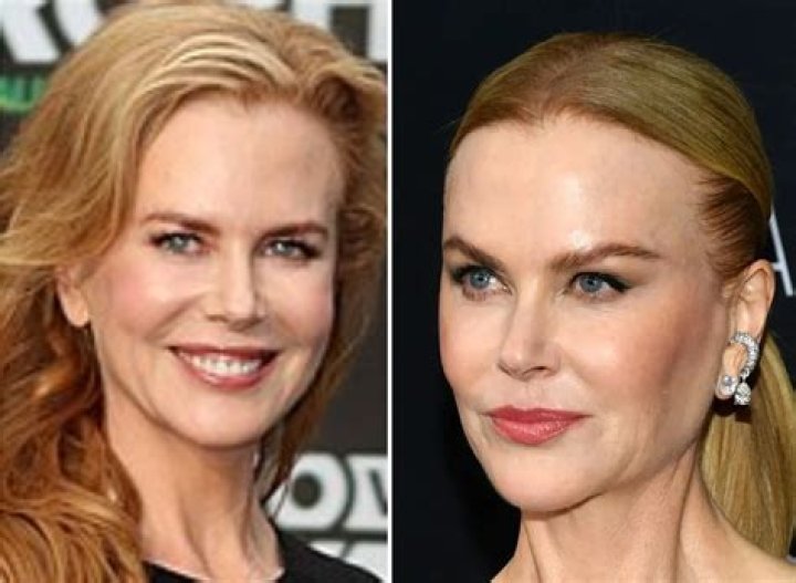 Did Nicole Kidman Go Under The Knife? Exploring The Plastic Surgery Rumors